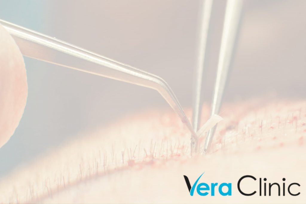 Which One Is The Best Hair Transplant In Turkey?